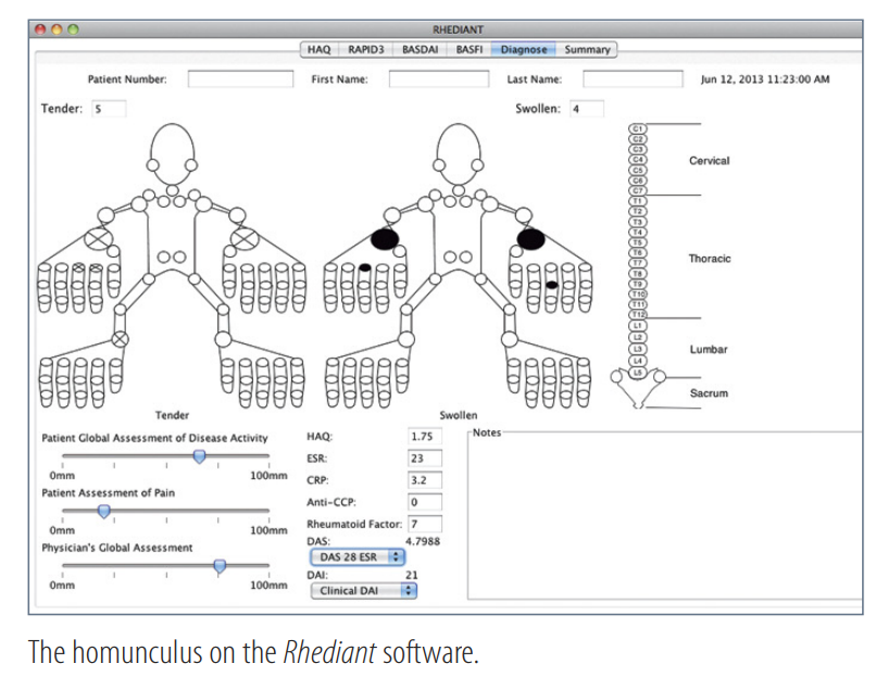 Reference example of a joint examination calculator with tender and swollen joint counts.
